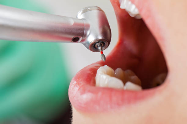 Best Broken or Chipped Tooth Repair in Thousand Oaks, CA